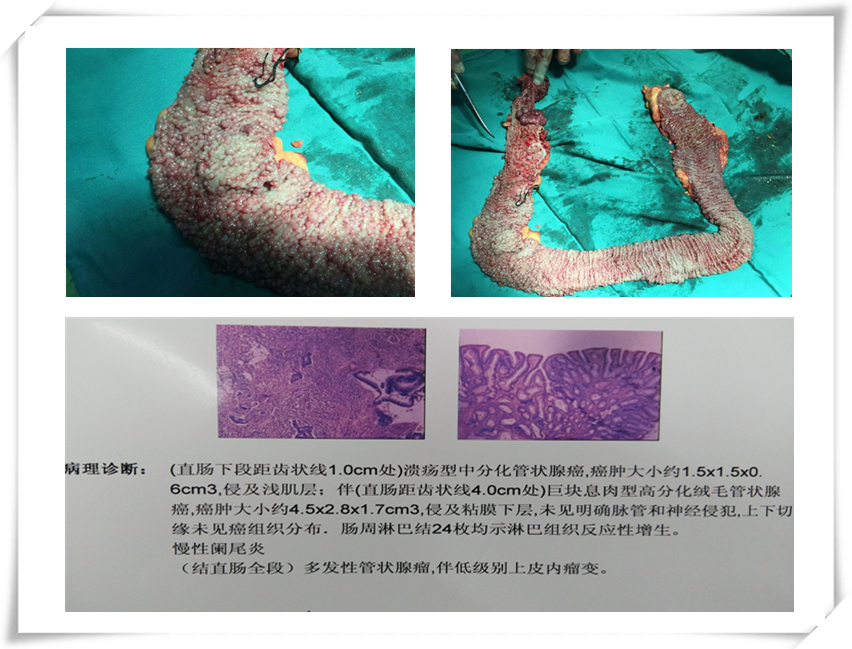 家族性腺瘤性肠息肉病一例